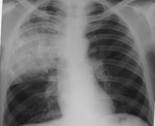 neumonia